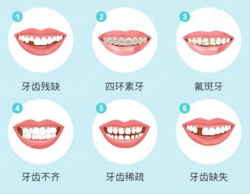 做完临时牙可以抽烟吗_当天能不能做临时假牙_临时牙当天可以做好吗