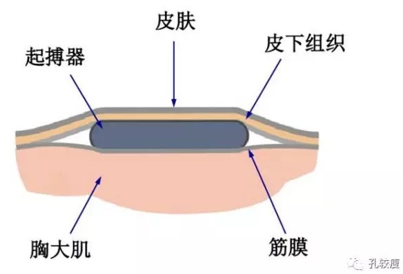 心脏起搏器基础教程-心脏起搏器：嘿，该跳啦