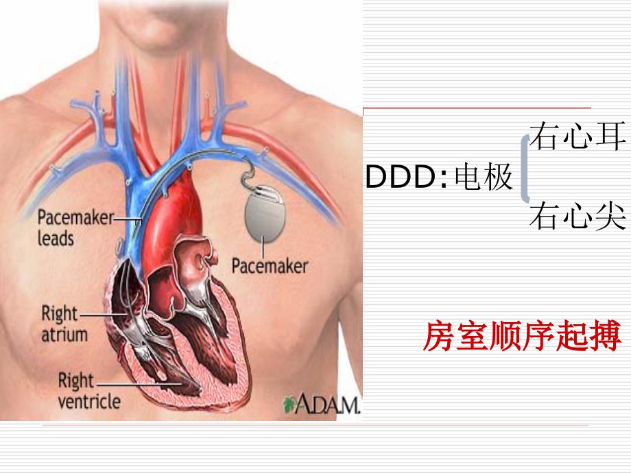 临床实用心脏起搏技术_心脏起搏器基础教程_心脏起搏器操作步骤