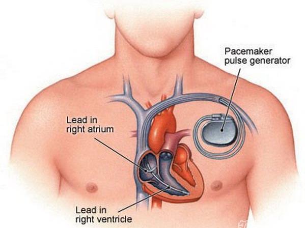 临床实用心脏起搏技术_心脏起搏器基础教程_心脏起搏器操作步骤