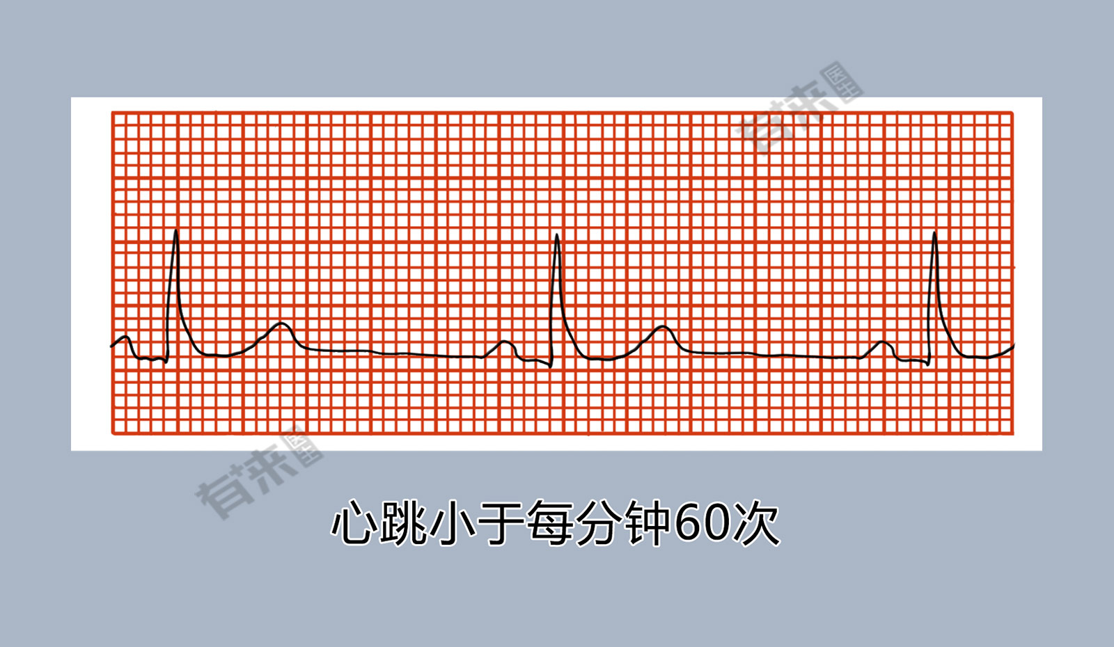 窦房结功能低下的表现-窦房结功能低下的症状及危害，你了解多少？